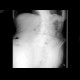 Development of ileus: X-ray - Plain radiograph